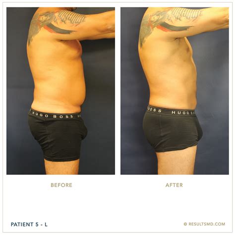 Best Male Liposuction Miami, FL 